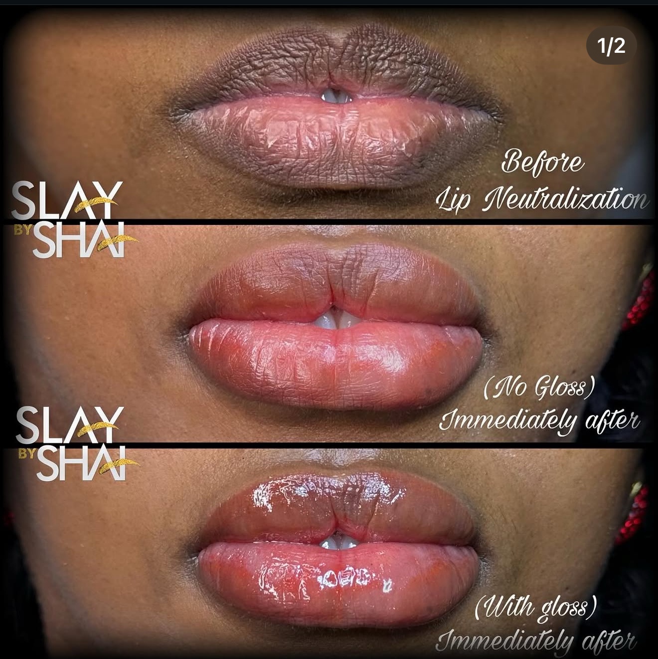 Original client lip neutralization before-and-after progression
