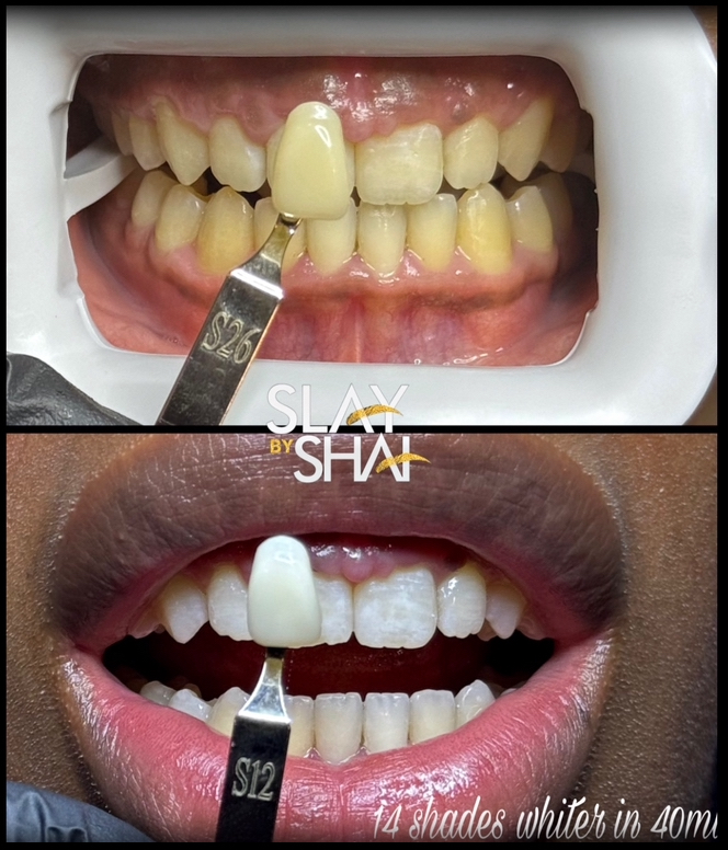 Original client teeth whitening before-and-after shade comparison